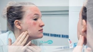 اگزمای پوستی