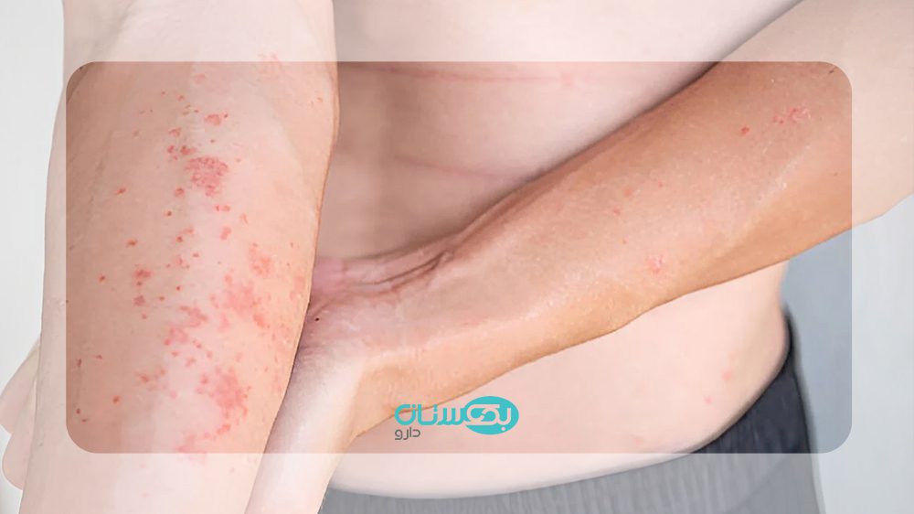 تصاویر اگزمای پوستی