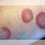 سارکوئیدوز