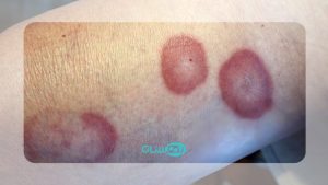 سارکوئیدوز